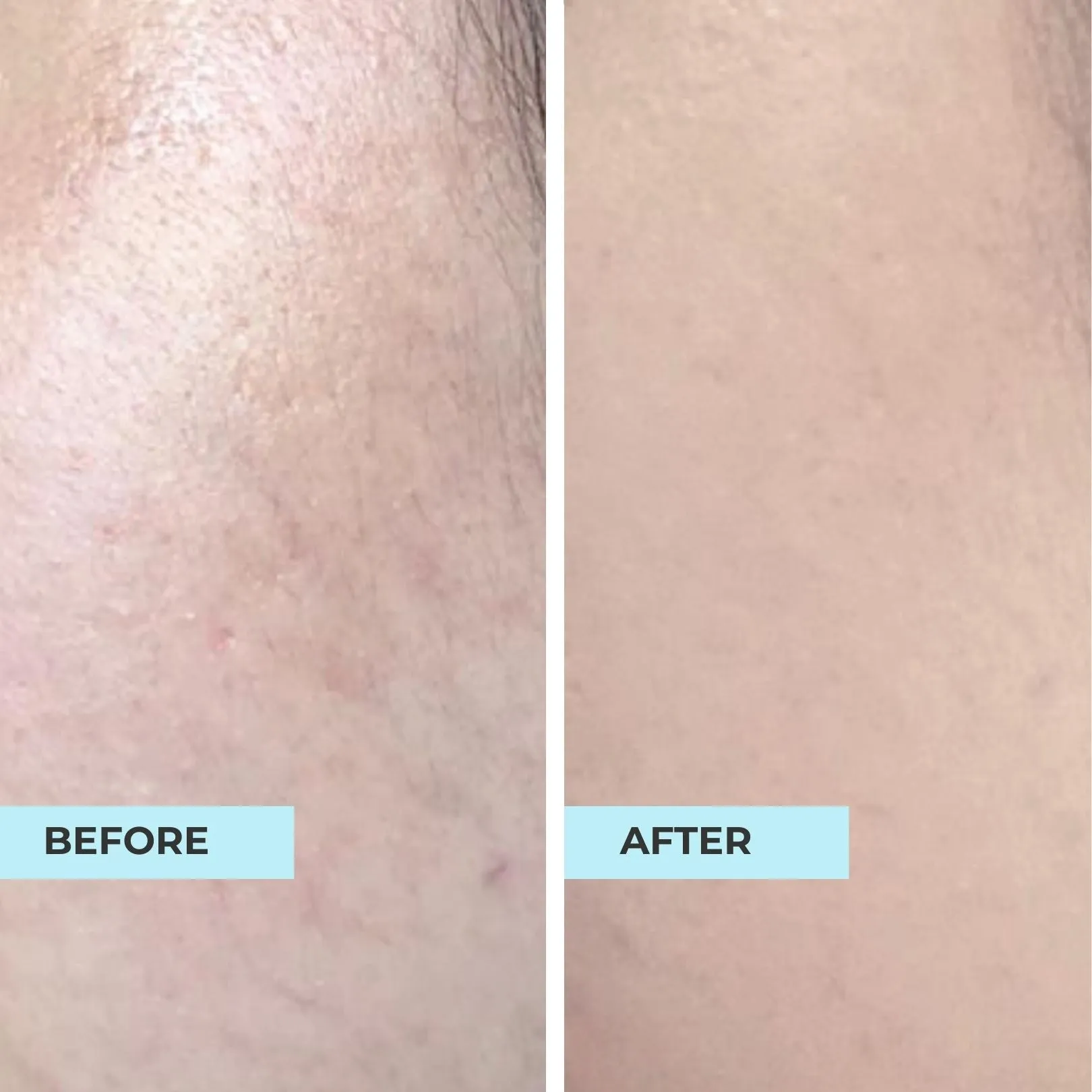 Anti-Blemish, Lighten Scars Kit