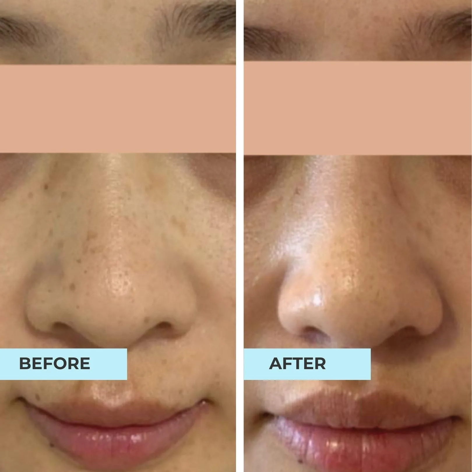 Anti-Blemish, Lighten Scars Kit