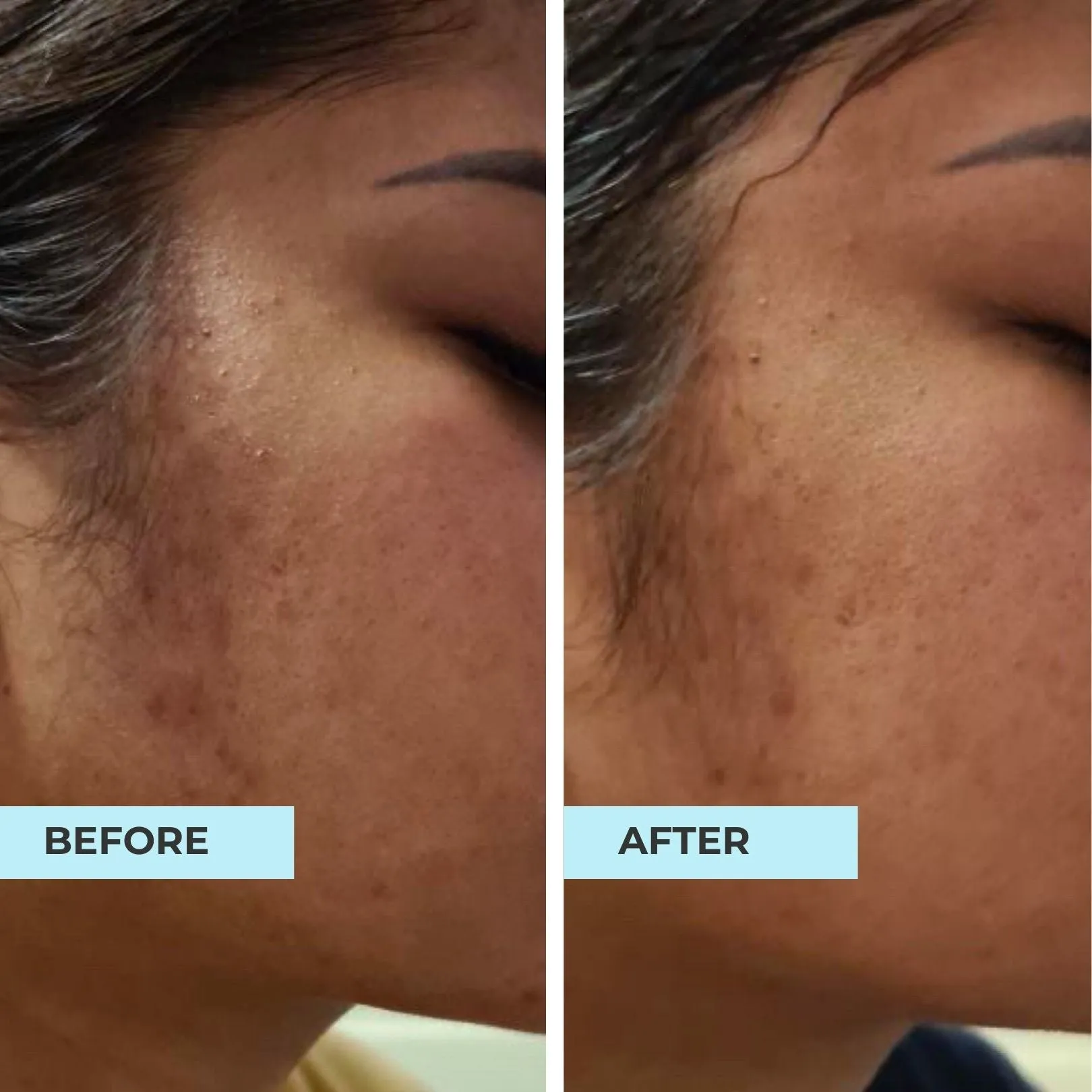 Anti-Blemish, Lighten Scars Kit