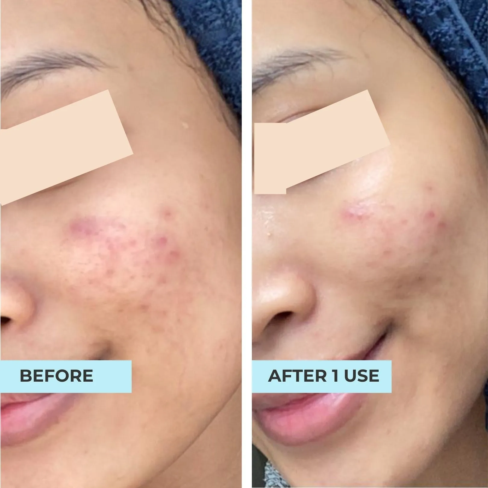 Anti-Blemish, Lighten Scars Kit